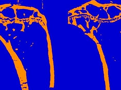 Investigadores del CNIO descubren la relación entre la psoriasis y la pérdida de masa ósea